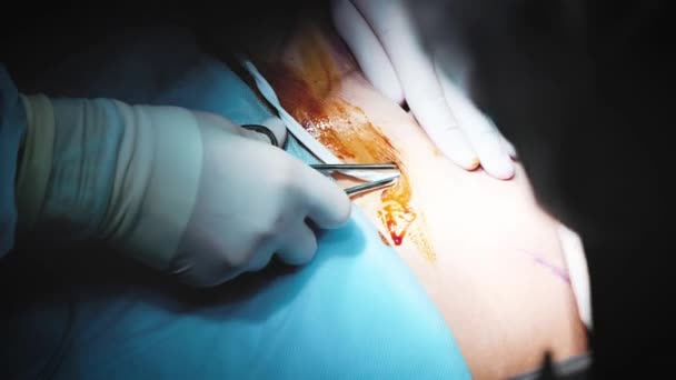 Gros plan mains portant des gants chirurgicaux équipe opératoire vêtements de protection effectuant la chirurgie à l'aide d'équipement stérilisé — Video