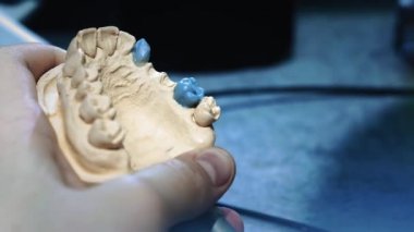 Diş hekimi çenesine takma diş takıyor. Dişçi elinde bir çene implantı tutuyor ve malzemeyi aletlerle uyguluyor. Modern dişçilik teknolojileri. Yakın plan, 4k..
