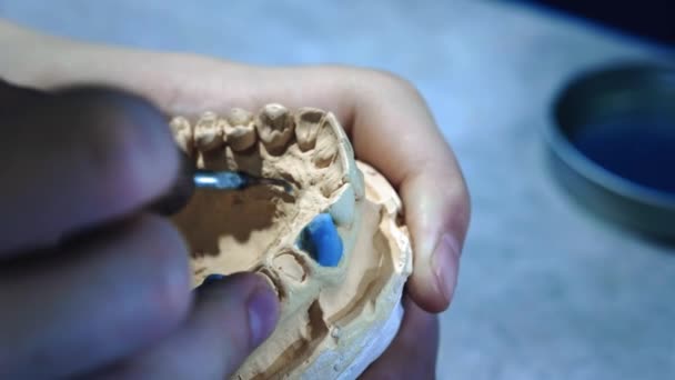 歯医者は顎に入れ歯を作る。歯科医は顎のインプラントを手に持ち、工具で材料を適用します。歯科の近代的な技術。接近中4k. — ストック動画