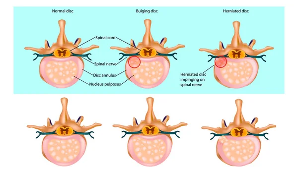 Desenho esquemático de hérnia do disco. Disco escorregado. Prolapso do disco intervertebral. Lesão no nervo espinhal. Estágios para uma hérnia de disco . —  Vetores de Stock