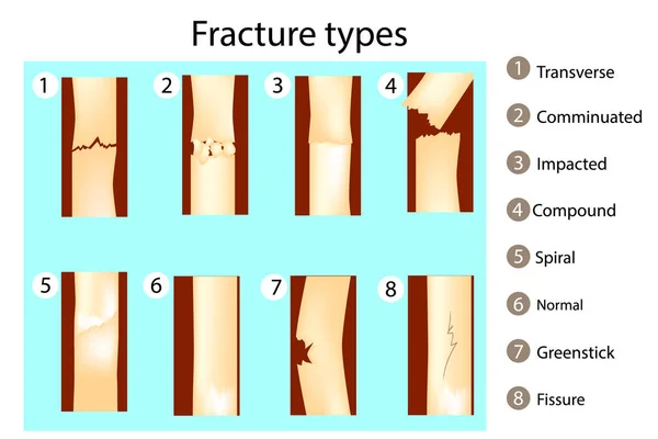 Tipos de fractura. Ilustración vectorial. Anatomía — Archivo Imágenes Vectoriales