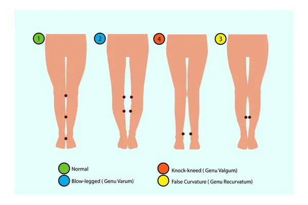 Tipos de curvatura de las piernas. Infografía — Archivo Imágenes Vectoriales