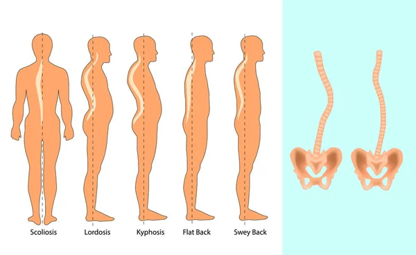 Deformação da coluna vertebral. Defeito da postura corporal . — Vetor de Stock