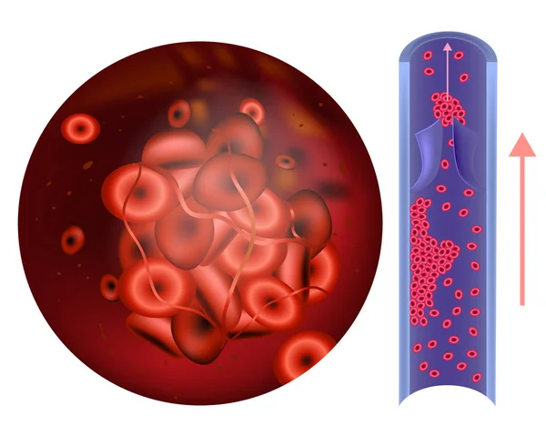 프로트 Thrombophilia입니다 Hypercoagulability Prothrombotic — 스톡 벡터