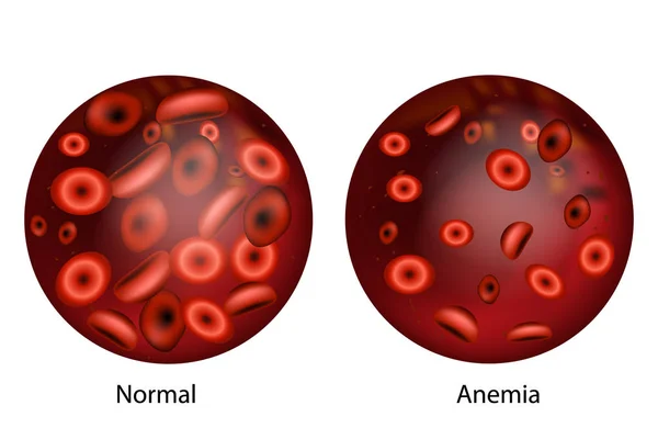 Anemia Por Deficiencia Hierro Diferencia Cantidad Anemia Glóbulos Rojos Normal — Vector de stock