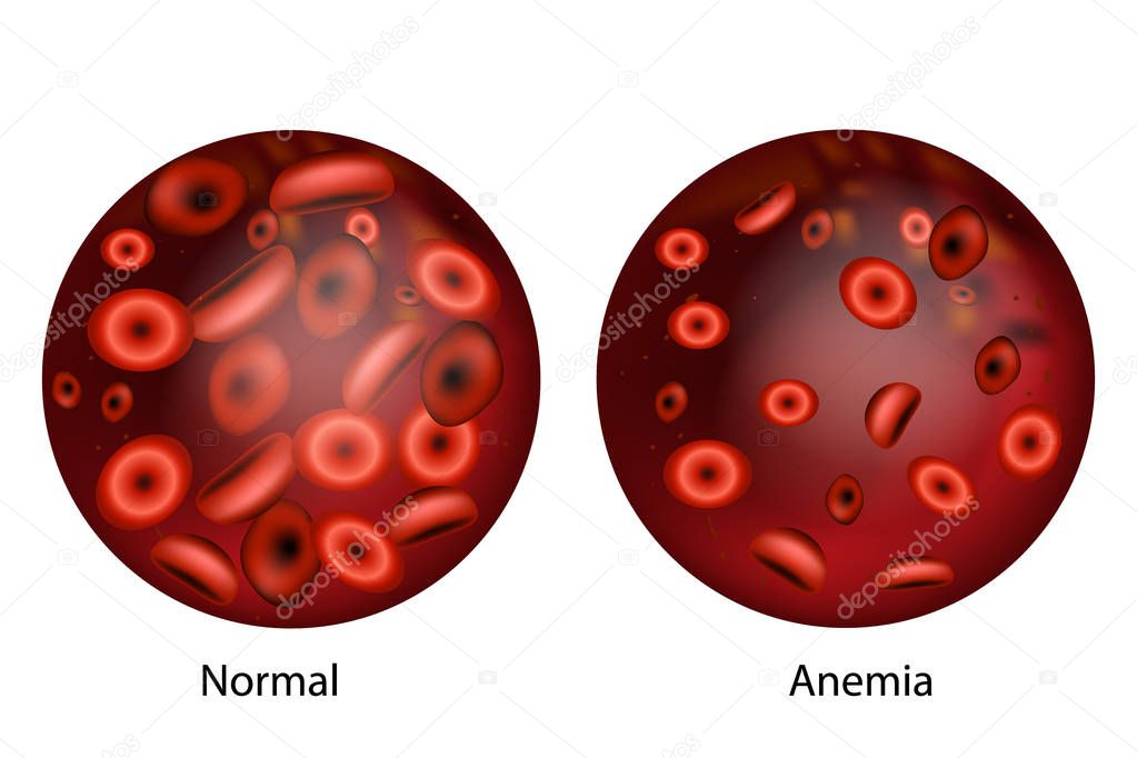 Fotos: anemia | Anemia Por Deficiencia Hierro Diferencia Cantidad