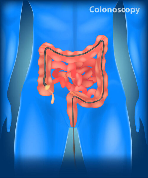 Illustration of Colonoscopy  in the colon