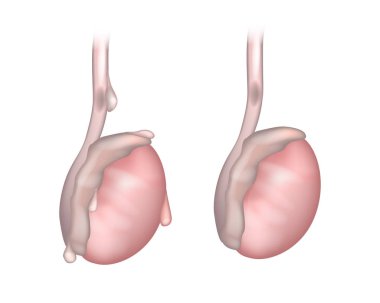 Side view of testicle showing twisted testicular appendage. An appendix testes (Hydatid of Morgagni). Testicular appendage torsion clipart