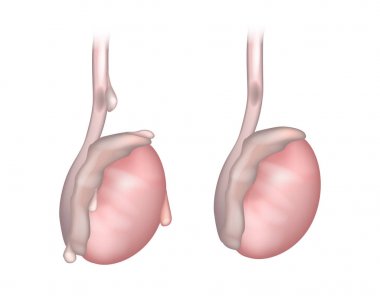 Side view of testicle showing twisted testicular appendage. An appendix testes (Hydatid of Morgagni). Testicular appendage torsion clipart