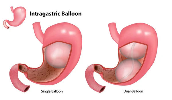 Intragastric Balon Türleri Çift Balon Tek Balon Bir Mide Içinde — Stok Vektör