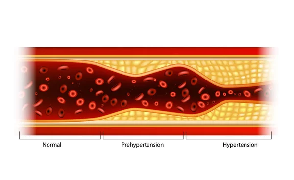 Hypertension Préhypertension Plaque Dans Les Vaisseaux Sanguins — Image vectorielle