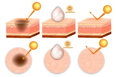 UV koruması. Önce ve sonra koruma UV yansıma deri. Korumak ve sağlıklı cilt güneşte destek