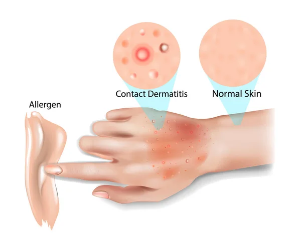 Huden Kontaktdermatit Allergisk Kontaktdermatit Irriterande Kontakteksem Fototoxisk Dermatit — Stock vektor