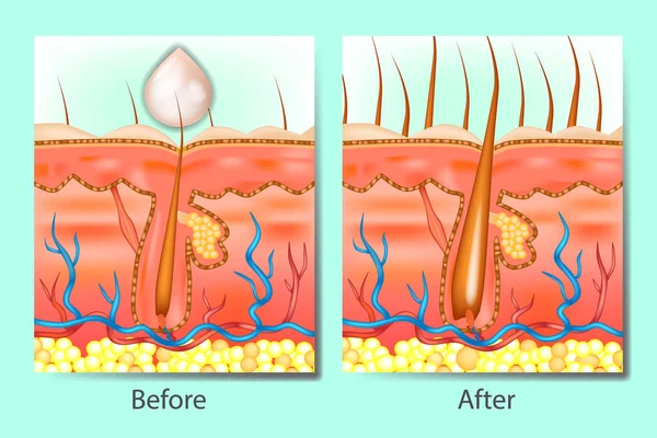 Estimulantes Del Crecimiento Del Cabello Antes Después Cabello Cuero Cabelludo — Archivo Imágenes Vectoriales