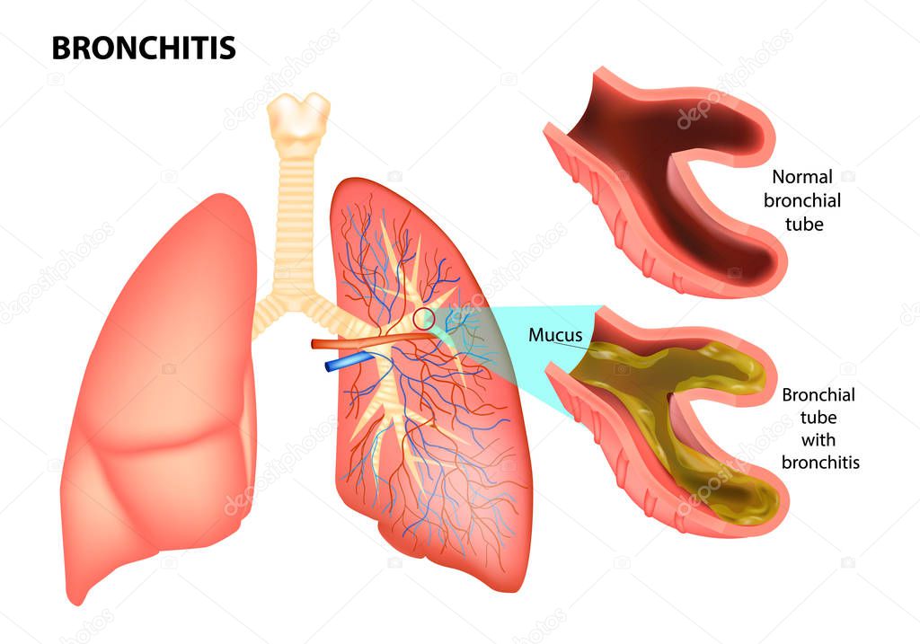 BRONCHITIS. Normal bronchial tube andBronchial tube with bronchitis. Vector illustration of lungs affected by bronchitis