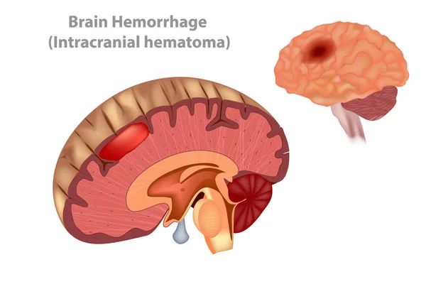 Hémorragie Cérébrale Hématome Intracrânien Vecteur — Image vectorielle