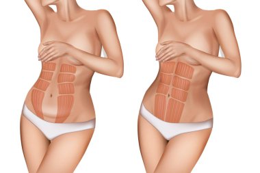 Diastasis recti veya rektus abdominis diastasis.
