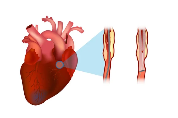 Stent Coronariano Dispositivo Forma Tubo Colocado Nas Artérias Coronárias Diagrama — Vetor de Stock