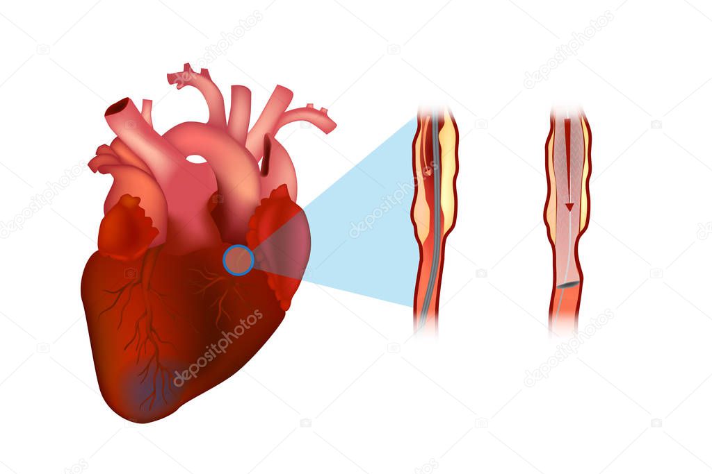 A coronary stent is a tube-shaped device placed in the coronary arteries. Diagram of stent placement