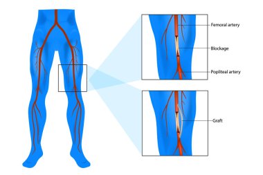 Femoral popliteal (femoropliteal veya Femopliteal) bypass ameliyatı. Doku nakli..  