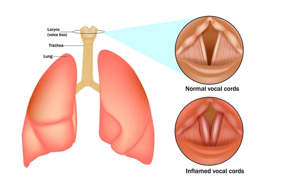 気管支炎 喉頭炎は喉頭の炎症である ボイスボックス — ストックベクタ