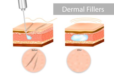 Dermal fillers, also known as 