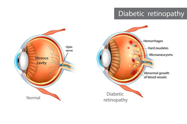Retinopatía Diabética Diferencia Entre Retina Normal Retinopatía Diabética — Archivo Imágenes Vectoriales