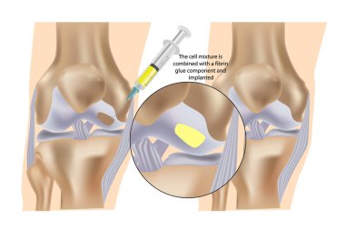Stem cell therapy ( Injections) for repair of knee cartilage.The cell mixture is combined with a fibrin glue component and implanted clipart