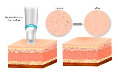 Blackhead Remover Deep Pore Vakum Vakumlama Vakumu. Blackhead Vakum Aspirasyon Aracı