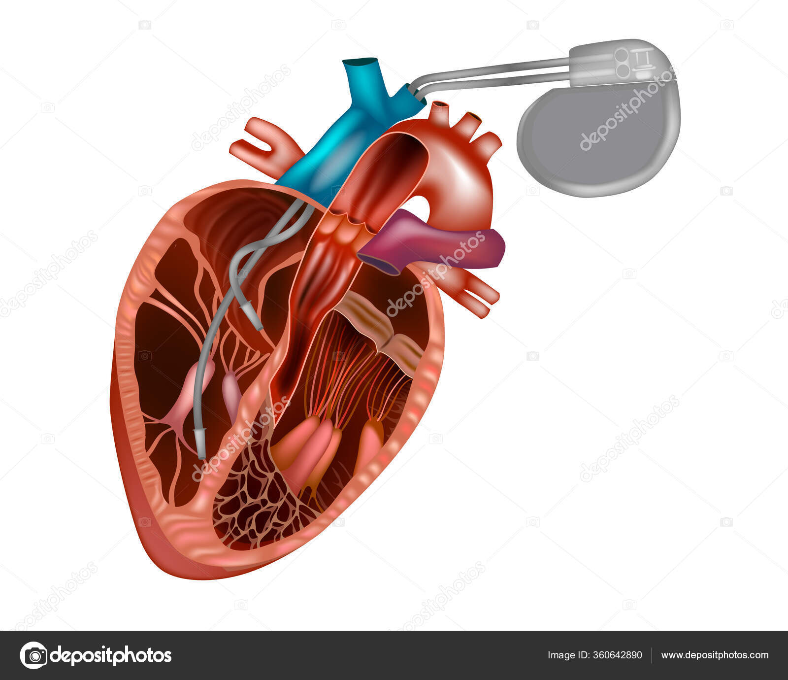 Marcapasosストックベクター ロイヤリティフリーmarcapasosイラスト ページ 2 Depositphotos