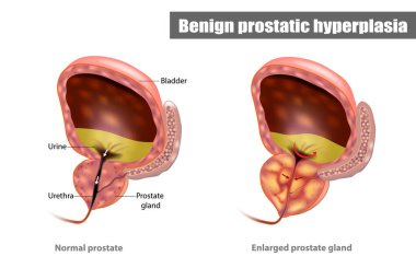 Prostat büyümesi olarak da adlandırılan iyi huylu protez hiperplazi (BPH)