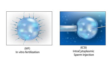 (ICSI) Intra Cytoplasmic Sperm Injection and (IVF) in vitro fertilization. clipart