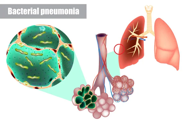 Akciğer Alveolünün Içindeki Bakteriler Bakteriyel Pnömoni Bakteriyel Enfeksiyon Streptococcus Pneumoniae — Stok Vektör