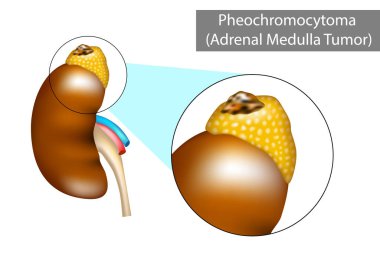 Pheokromositoma (PH veya PCC). Adrenal Bez Tümörü