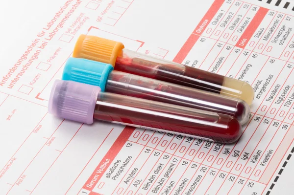 혈액 검사, 혈액 샘플을 실험실 폼에 — 스톡 사진