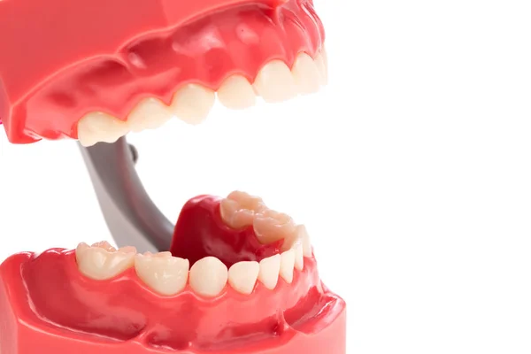 Dilatation of teeth, dentition — Stock Photo, Image