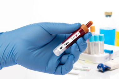HIV, AIDS testi. Laboratuvarda üzerinde kan olan bir test tüpü bulunduruyor.