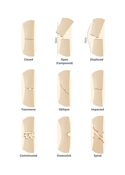 Type of fracture illustration vector on white background. Health — Stock Vector