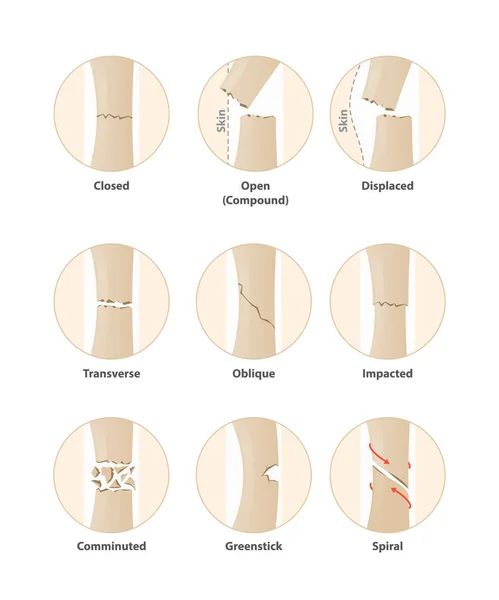 Type of fracture in circle line illustration vector on white bac — Stock Vector