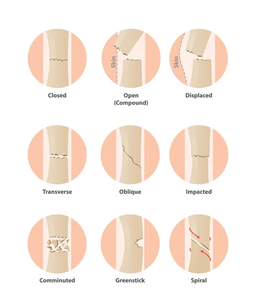 Type of fracture in circle illustration vector on white backgrou — Stock Vector