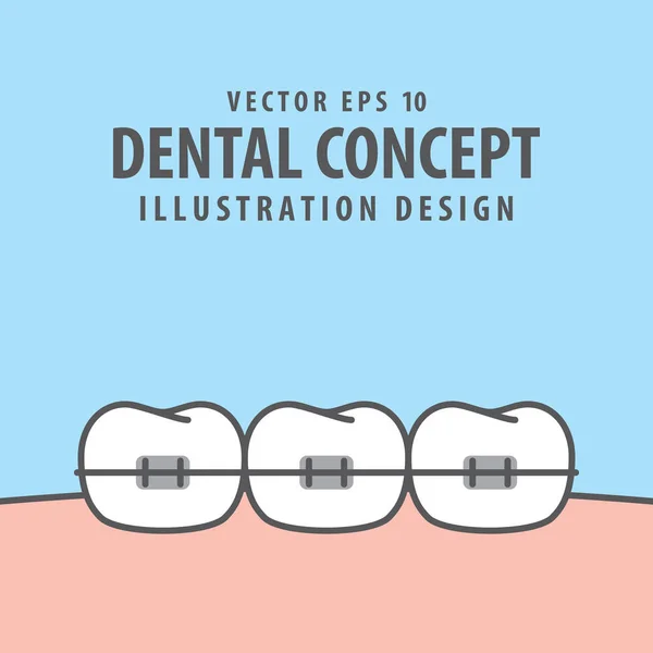 Vector de ilustración de dientes ortodónticos sobre fondo azul. Denta. — Vector de stock