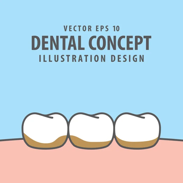 Tártaro ou cálculo dentes ilustração vetor no fundo azul . —  Vetores de Stock