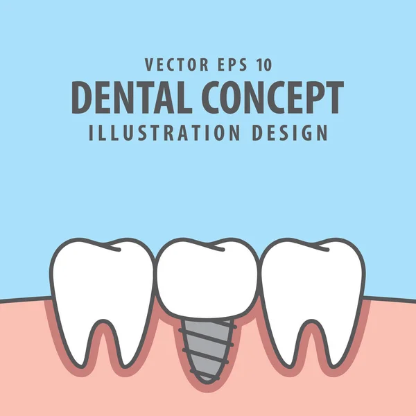 Implante dental entre dientes reales vector de ilustración en bac azul — Archivo Imágenes Vectoriales