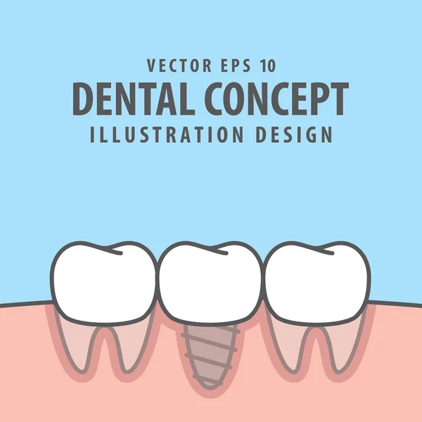 Dent d'implant entre les dents réelles illustration vecteur sur bleu bac — Image vectorielle
