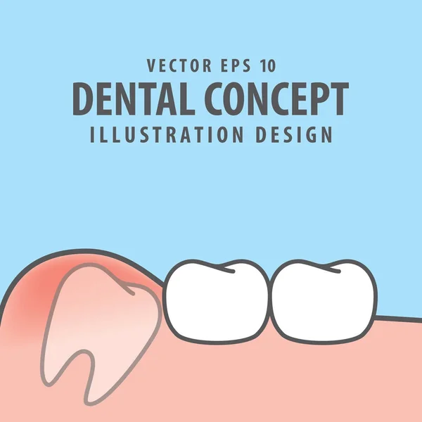 Diente impactado en el interior bajo inflamación encía ilustración vector — Vector de stock