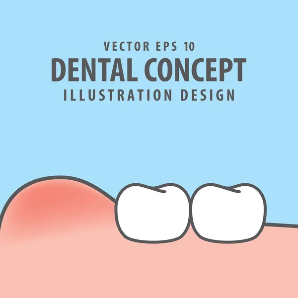 Набрякають ясна з ілюстрацією зубів Вектор на синьому фоні . — стоковий вектор