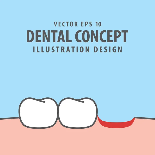 Vector de ilustración diente caído sobre fondo azul. Conc dental — Vector de stock