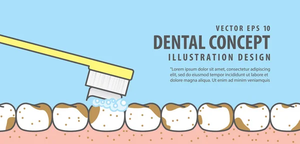 Banner Cepillado dientes muy sucios y vector de ilustración de encías en — Vector de stock