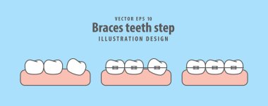 Diş telleri diş adım illüstrasyon vektör mavi zemin üzerine. Diş