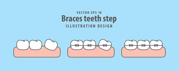 Frenos dientes paso ilustración vector sobre fondo azul. Dental — Archivo Imágenes Vectoriales